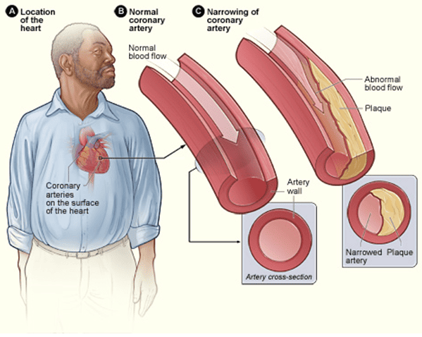 Heart Disease Risk Assessment