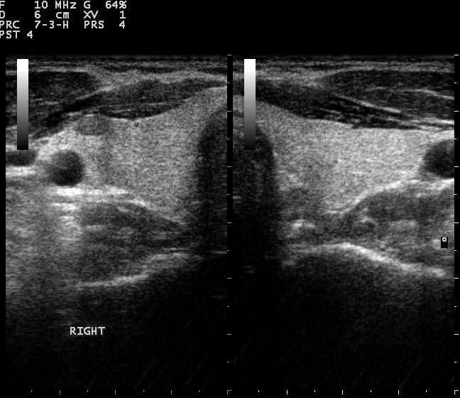 Thyroid Disorders