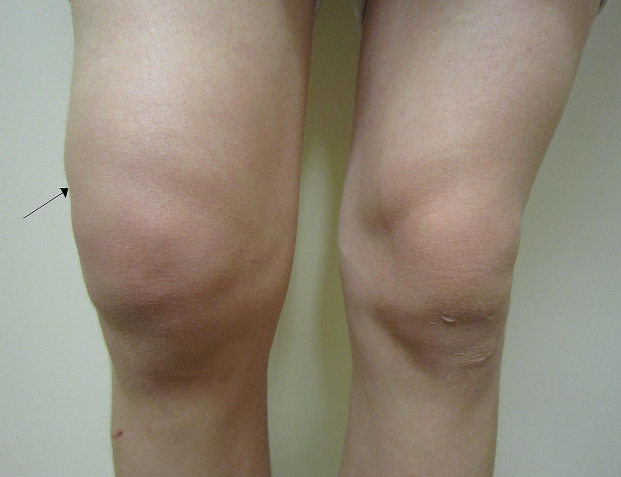 Joint Pain & Inflammation