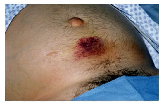 Pancreatitis