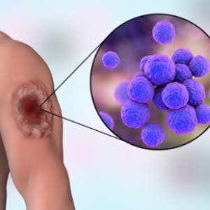 Skin & Soft Tissue Infections